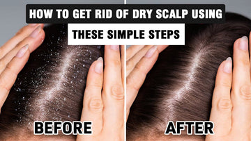 How To Get Rid of Dry Scalp Using These Simple Steps